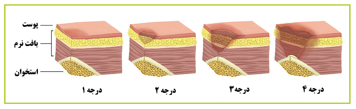 درمان زخم بستر توسط سالدیده