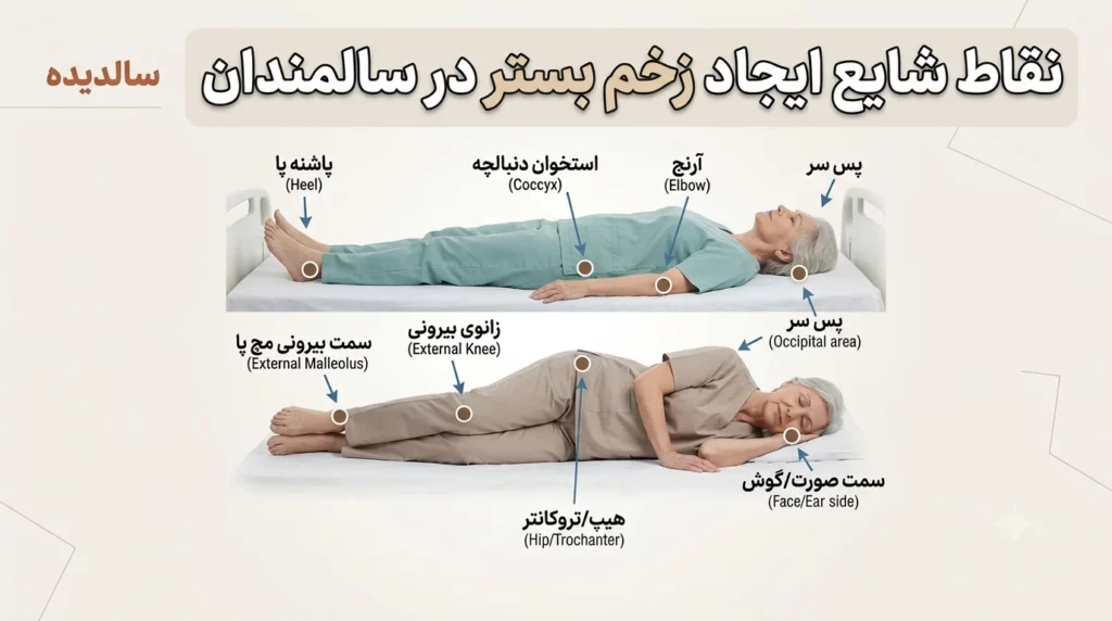 نقاط مستعد ایجاد زخم بستر در بدن سالمندان